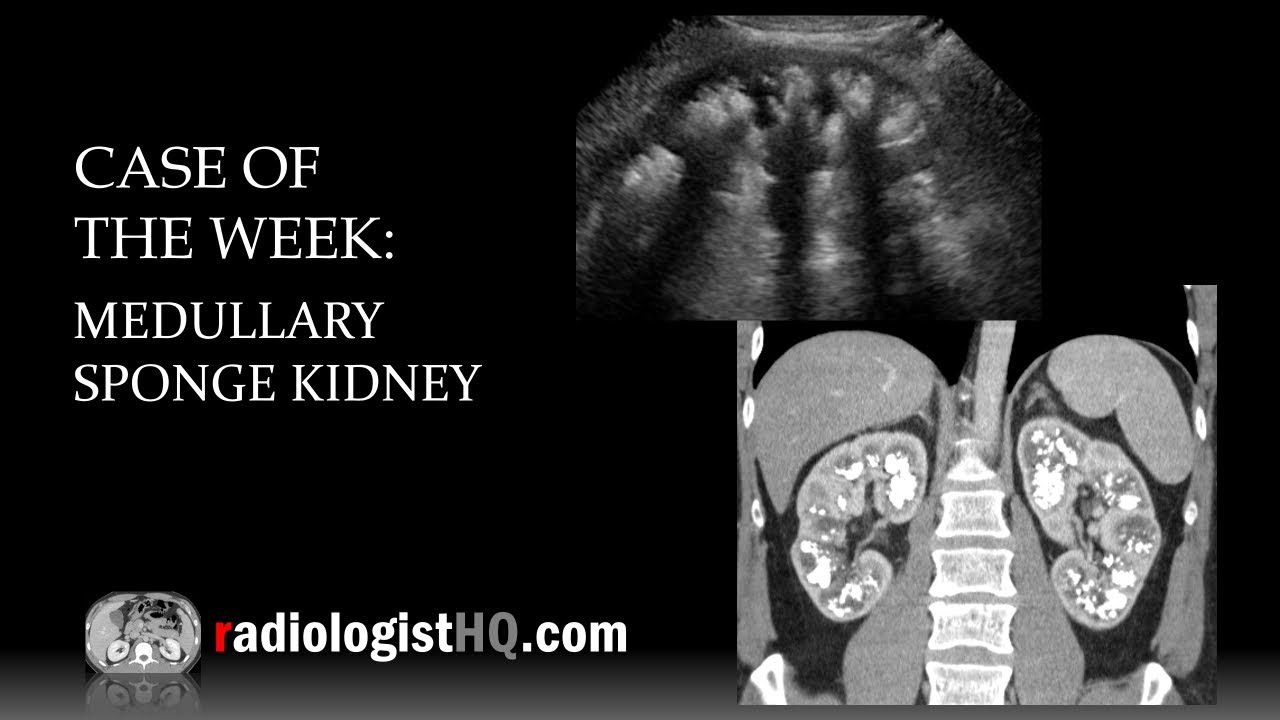 Case of the Week: Medullary Sponge Kidney (Ultrasound & CT)