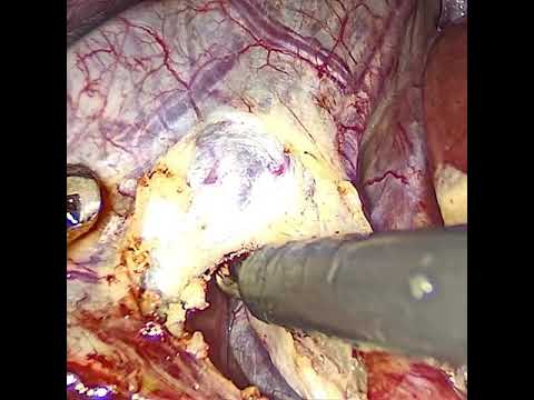 CATERPILLER HUMP ,Mohinhem hump(anamolous rt.hepatic artery laparoscopic cholecystectomy)