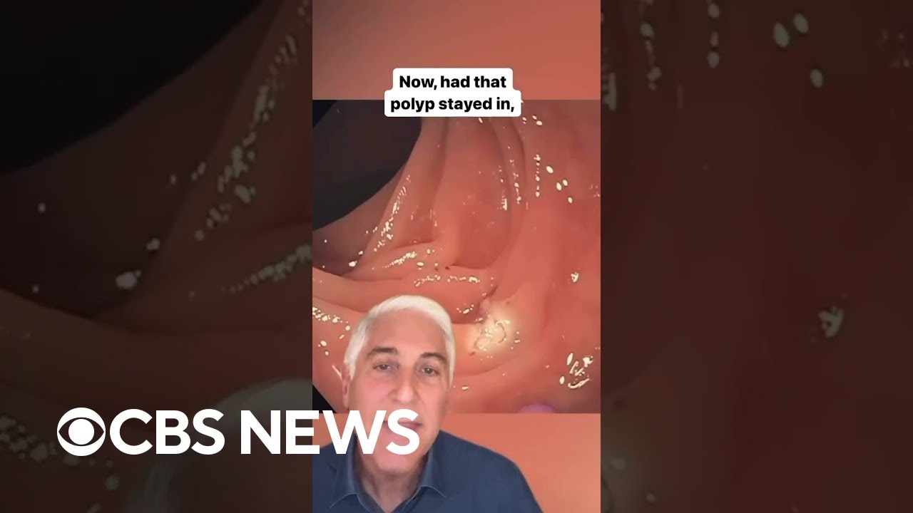 CBS News’ Dr. Jon LaPook demonstrates how colonoscopies can save your life #shorts