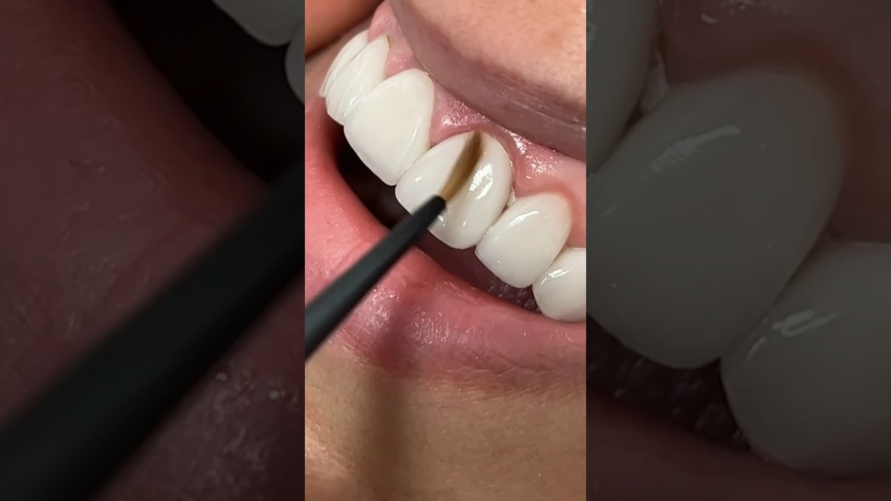 Celebrity Smiles over Bleaching Shade Tabs #dental #dentist #teeth #shortvideo #shorts #smile