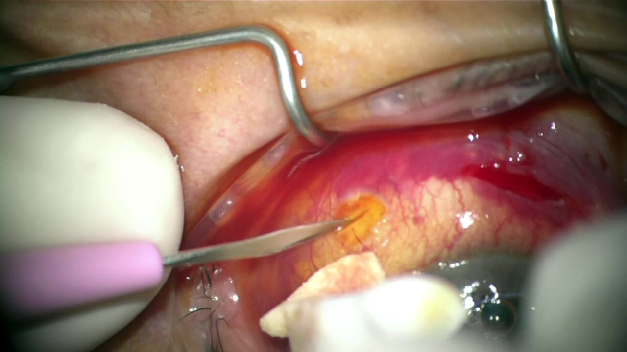 CHOROIDAL DETACHMENT DRAINAGE - Prof Dr Volkan DAYANIR