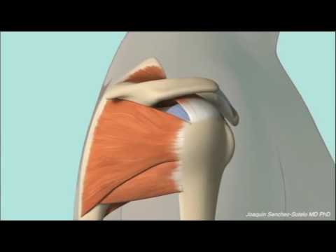 Chronic Subacromial Impingement Animation