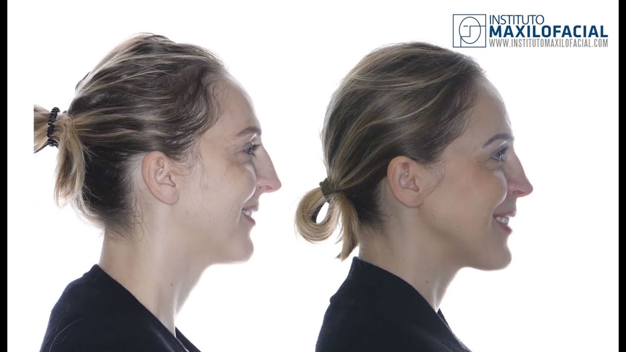 Cirugía Ortognática Bimaxilar. Surgery First. Caso #49: Alicja - Biretrusión