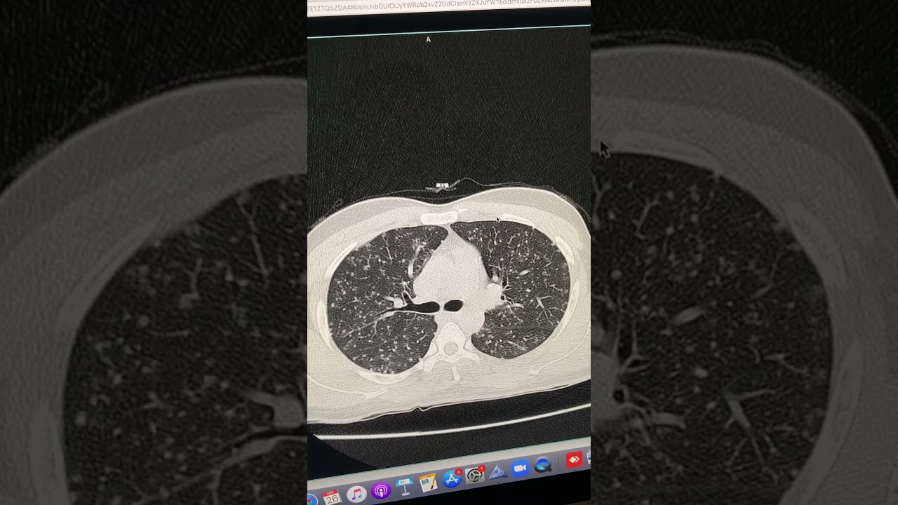 Classic Miliary TB - Not to miss on CT chest