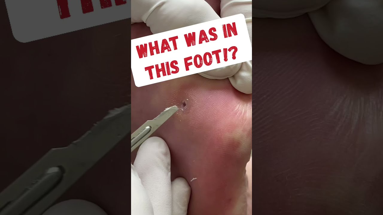 CLOGGED SWEAT GLAND IN FOOT!😱 #Shorts