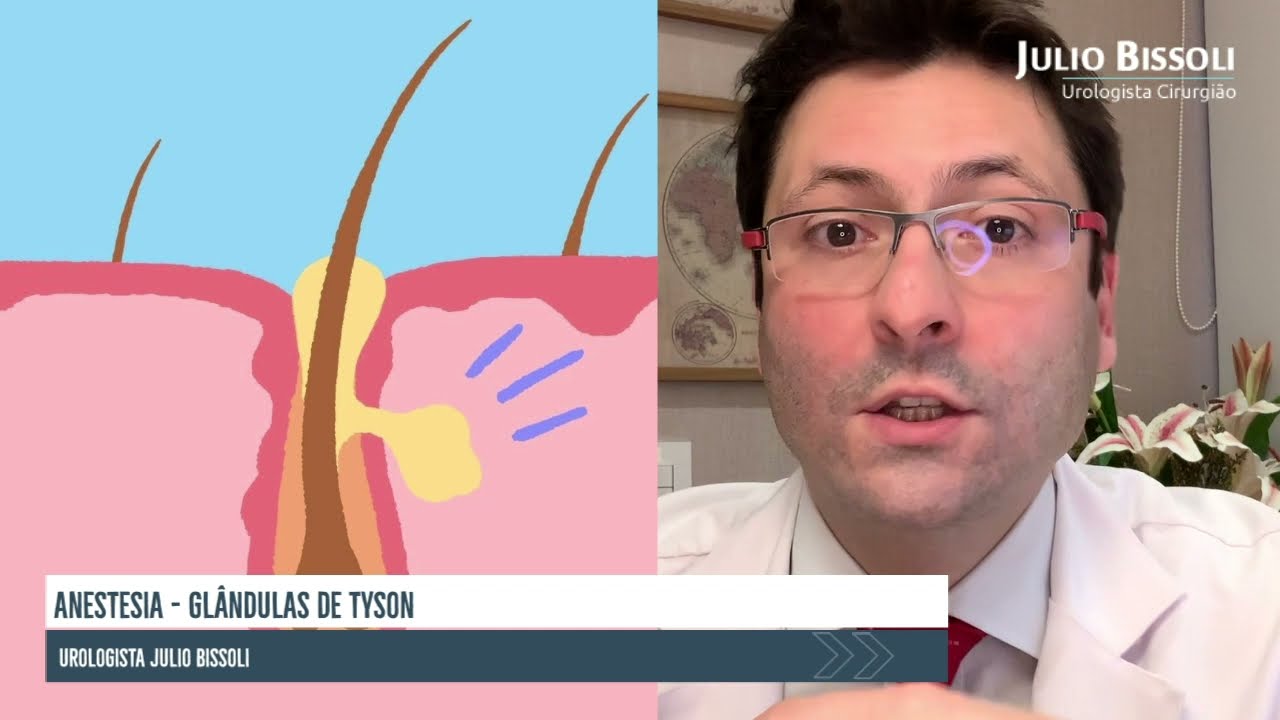 Como é a Anestesia para a retirada das Glândulas de Tyson?