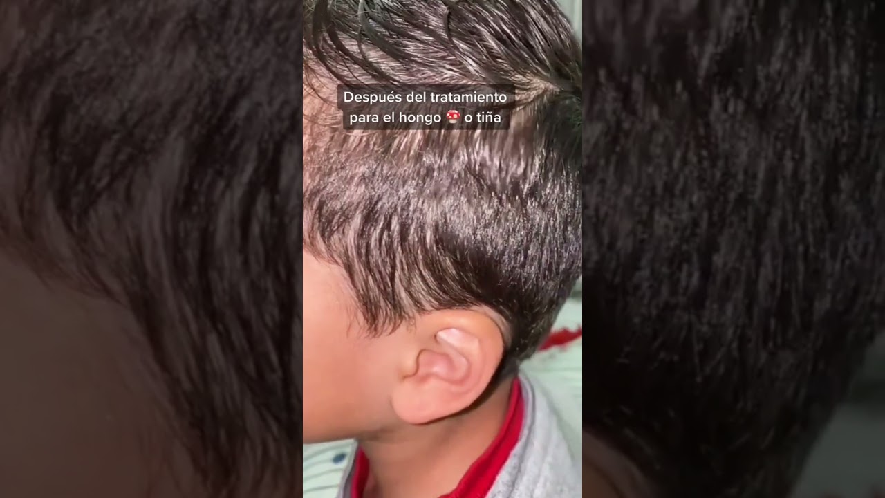 como mejorar los hongos me pidieron el antes y después del hongo