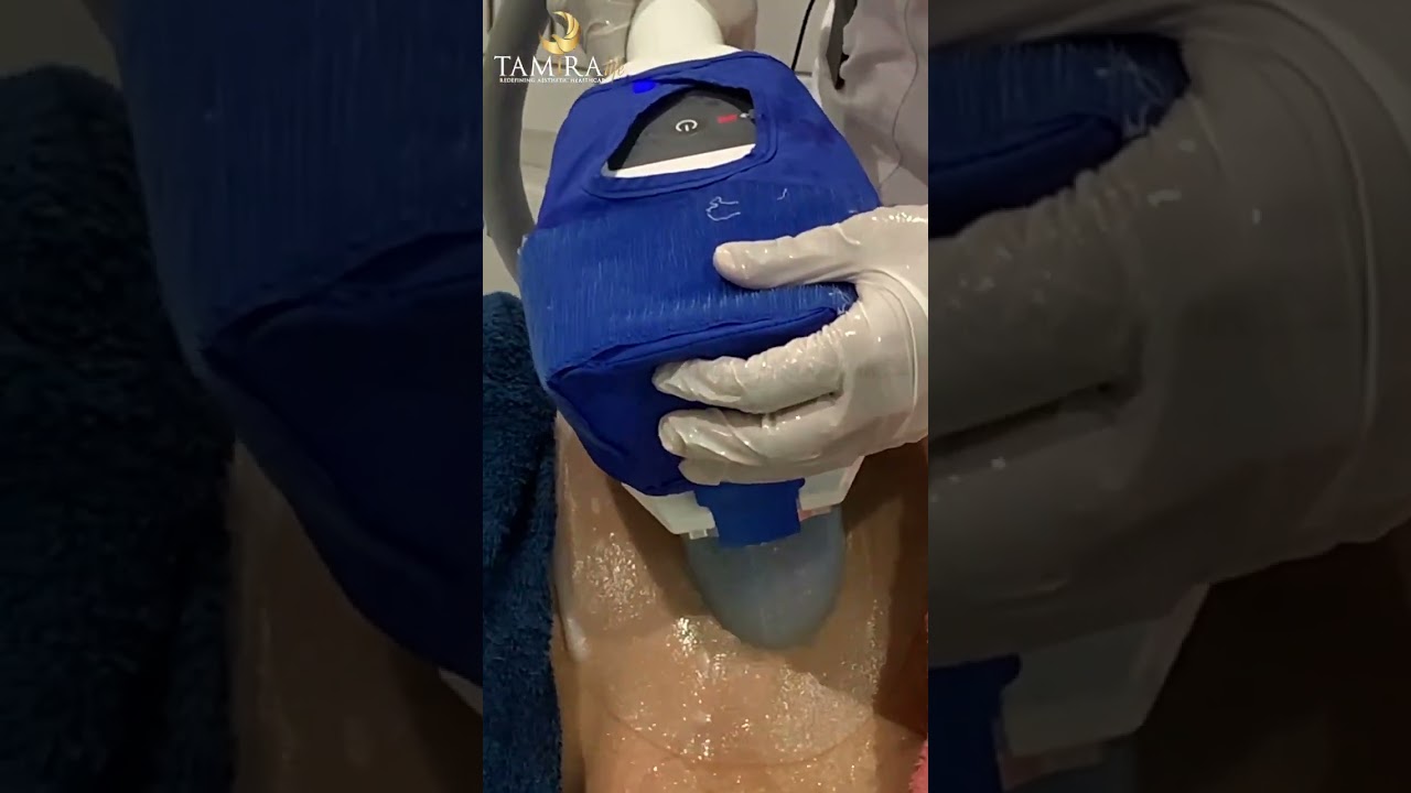 Coolsculpting Procedure (What do you need to know?)