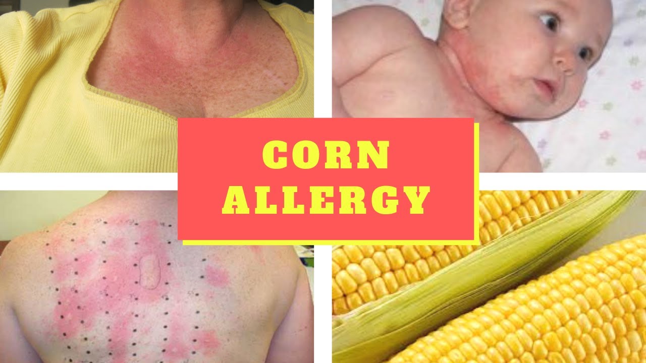Corn allergy Symptoms – Causes Symptoms and Pictures of Corn allergy Skin Rash in Kids Adults