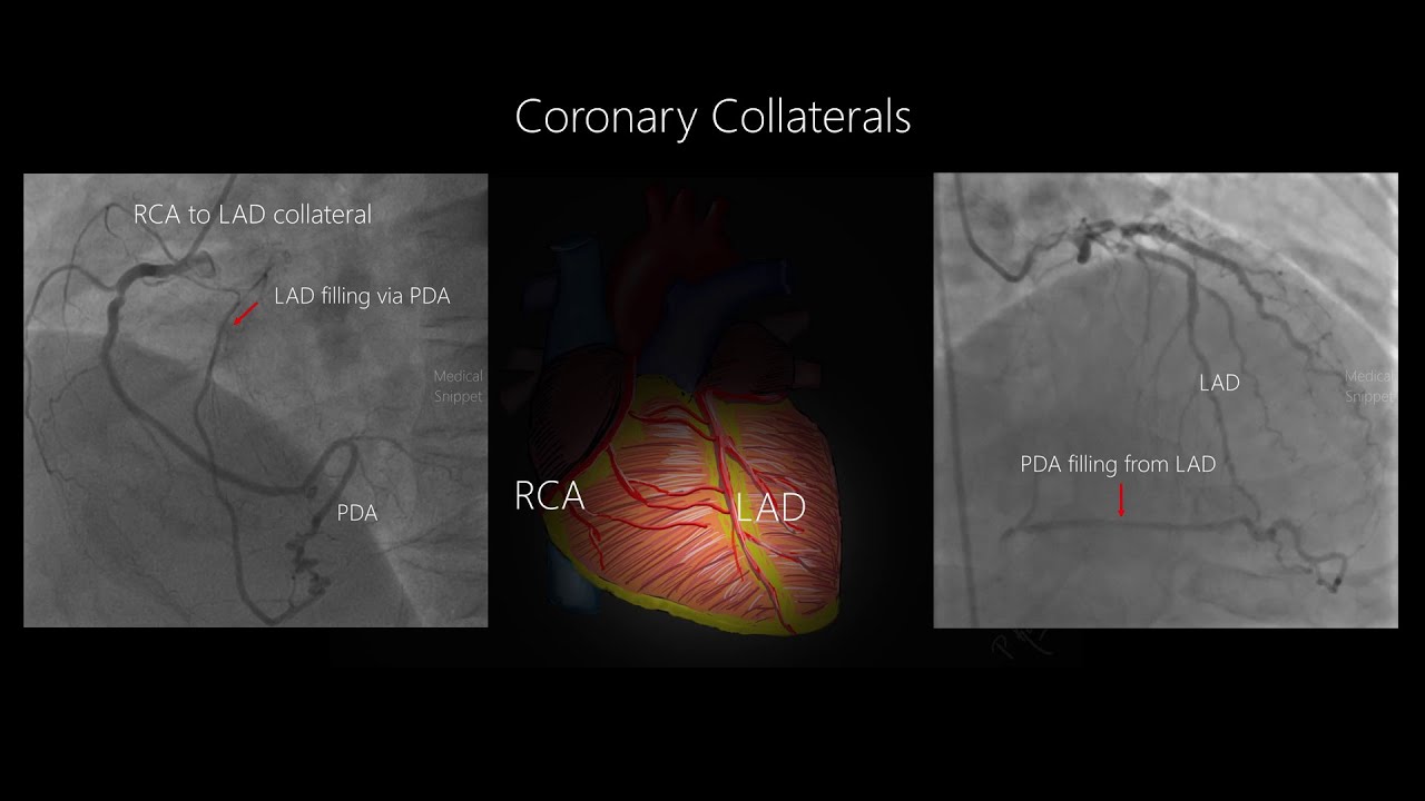 Coronary Collateral Circulation with Angiographic examples