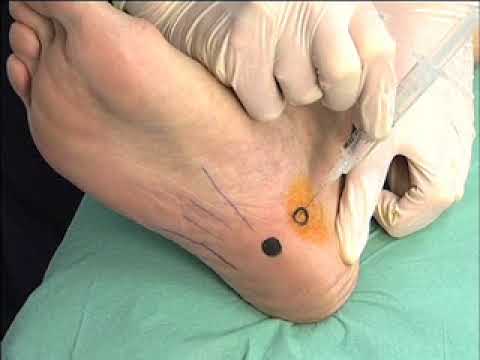 Corticosteroids – plantar fasciitis injection