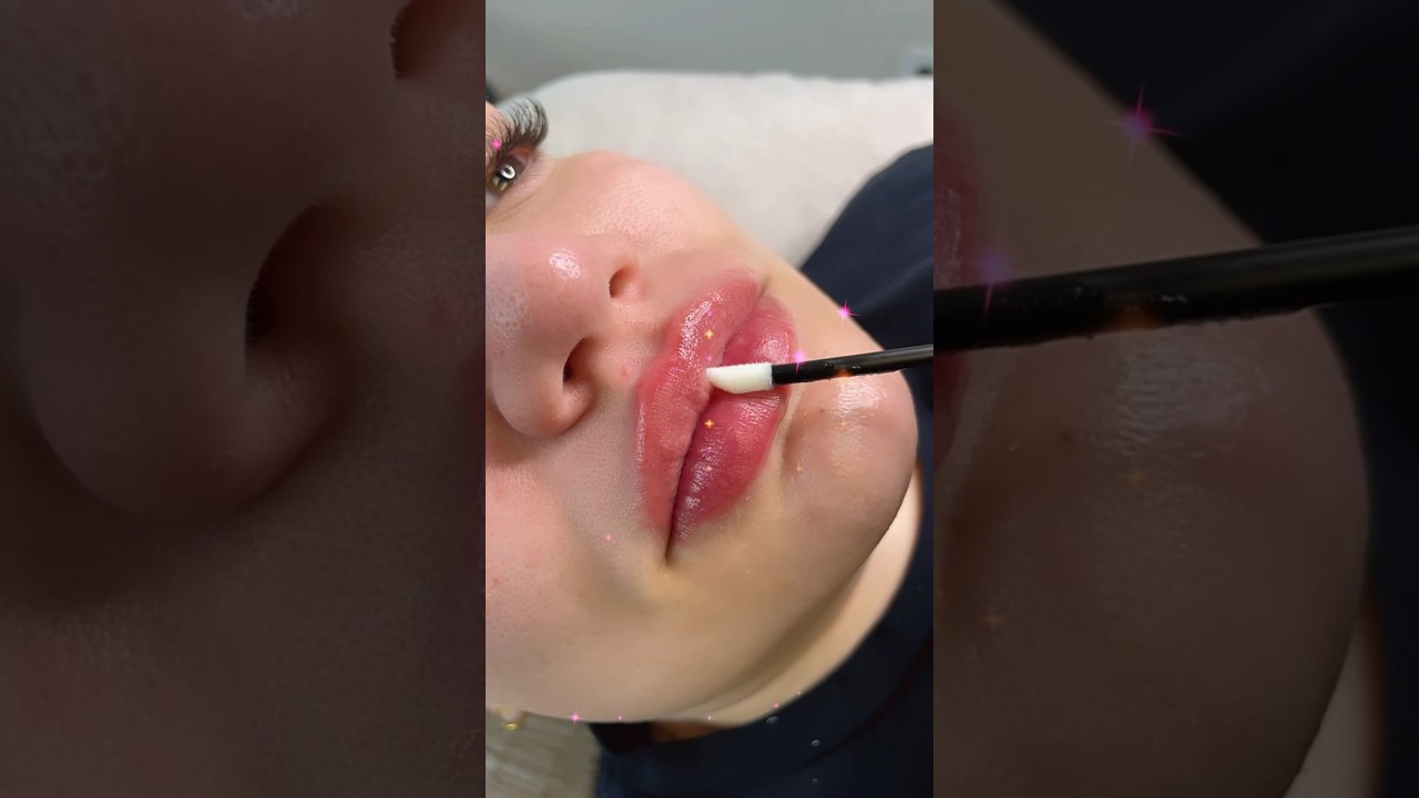 Creating the most perfect pout!!!! 🫦💋👄 #lipfillers #lipfiller # #lips #pout #lipfillerinjections