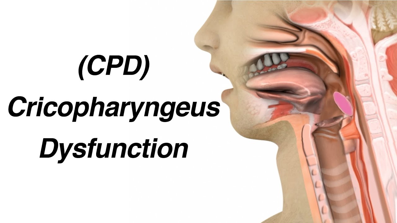 Cricopharyngeus Dysfunction (CPD) Causing Dysphagia or Trouble Swallowing