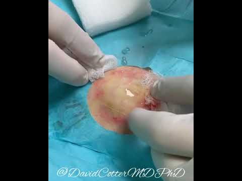 #Cyst drainage
