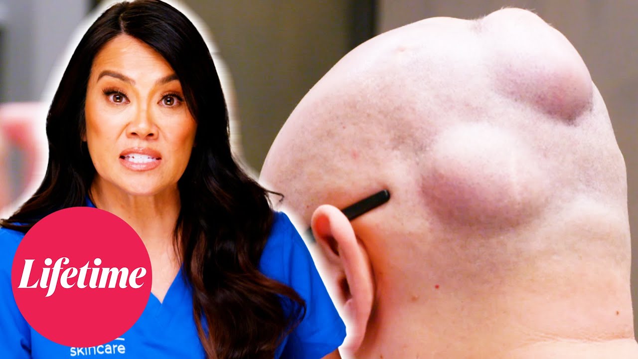 Cysts on Top of Cysts! | Dr. Pimple Popper: Breaking Out (S1) | Lifetime