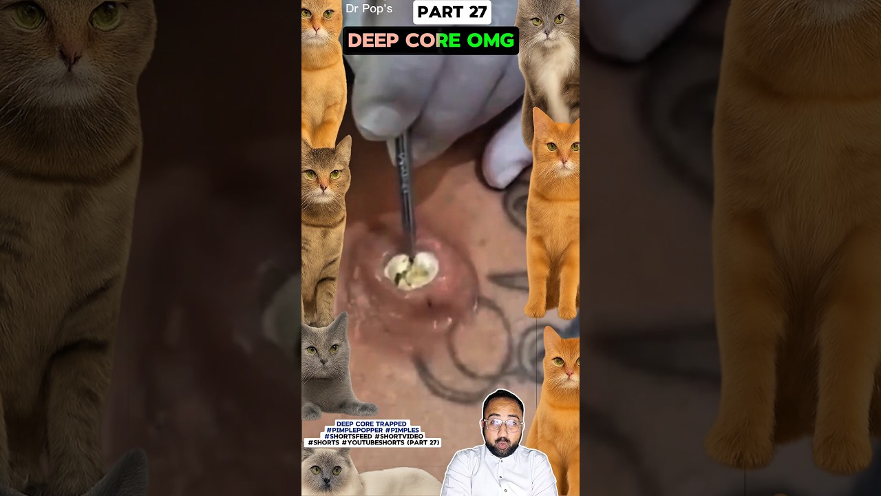 Deep Core Trapped #pimplepopper #pimples #shortsfeed #shortvideo #shorts #youtubeshorts (Part 27)