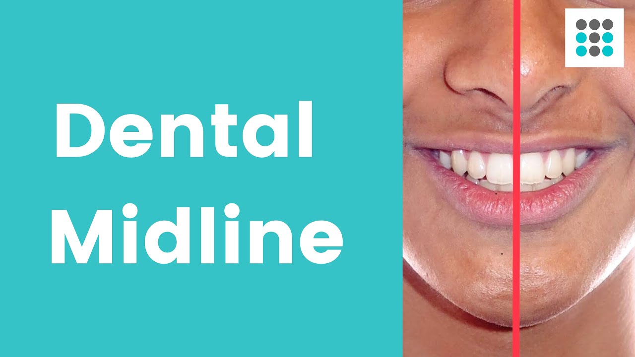 DENTAL MIDLINE SHIFT: What, why, and how to correct l Dr. Melissa Bailey