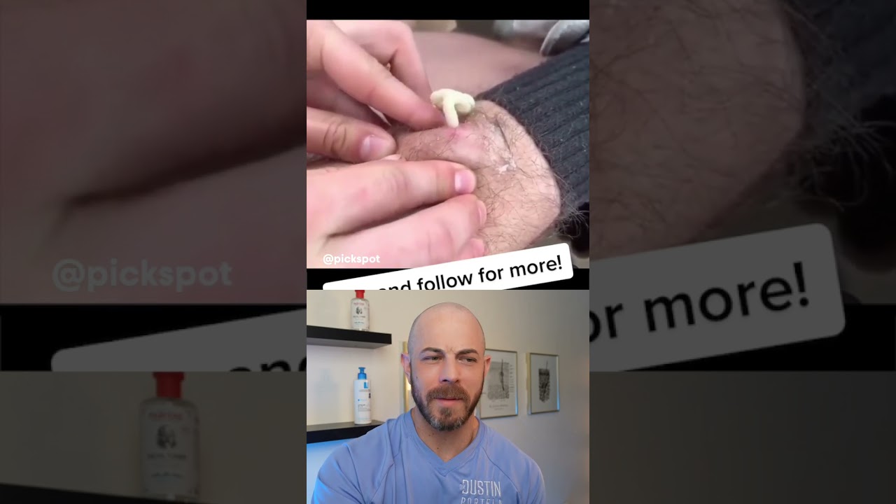 Dermatologist reacts to pus-filled cyst pop! #dermreacts #cystpopping
