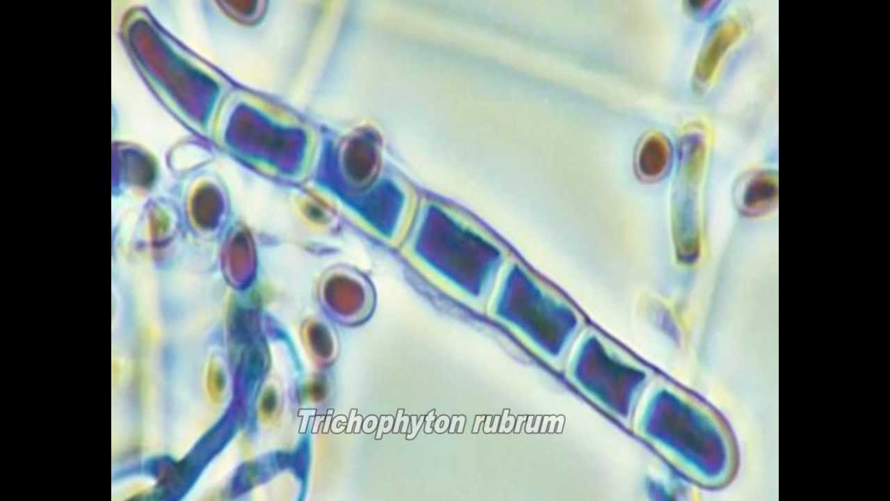 Dermatophytes (Ringworm): Microsporum & Trichophyton Fungi