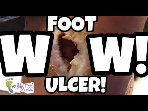 DIABETES FOOT DISASTER! DEEP GAPING HOLE IN FOOT AND SEVERELY THICK DEFORMED NAILS ON A CHARCOT FOOT