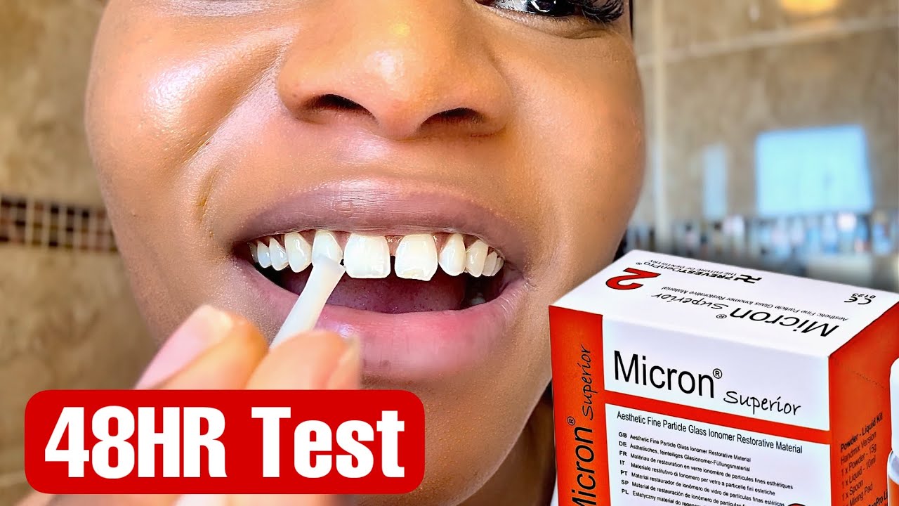 DIY Chipped Tooth Repair At Home Filling HONEST REVIEW |  Micron Superior |