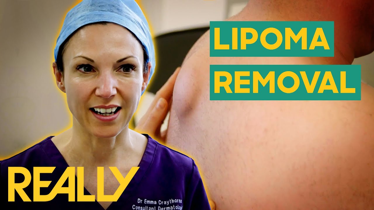 Dr. Emma Removes An Abnormally Large Lipoma From A Patient's Back | The Bad Skin Clinic