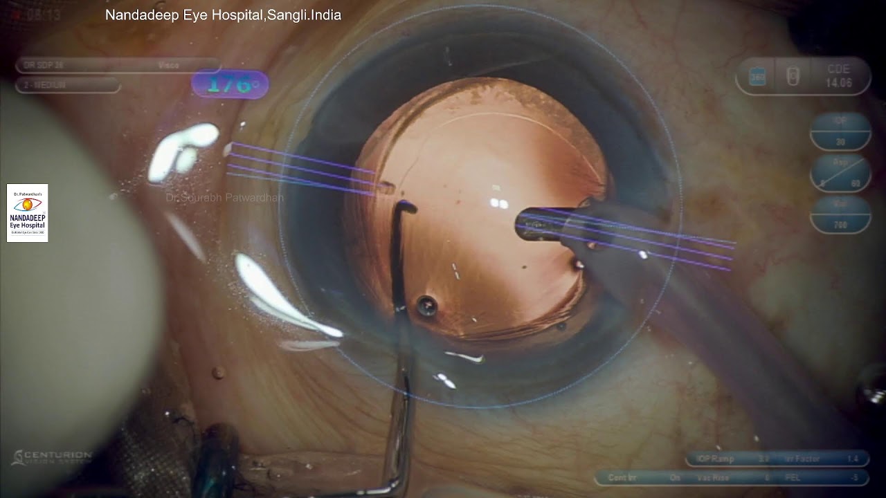 Dr Sourabh Patwardhan Live Cataract surgery. For training 7028402375 Luxor Revalia