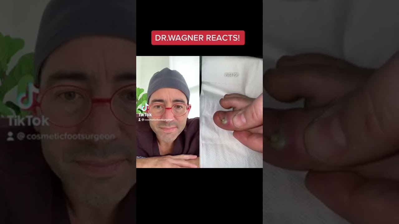 DRAINAGE OF PUS-FILLED PIMPLE😬#shorts #pimple #comedy #cyst