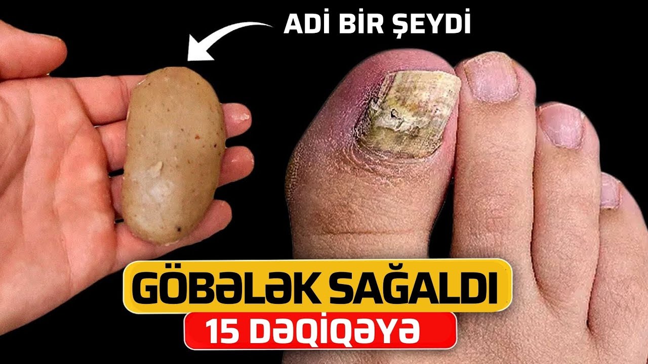 Dırnaq Göbələyi 15 Dəqiqəyə Sağalacaq - Hər kəsin Evində Var