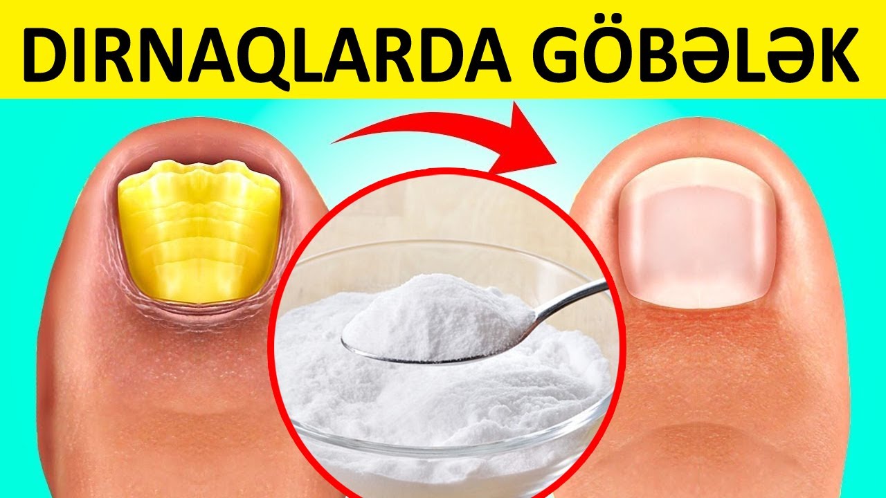 Dırnaqlarda göbələyin XALQ TƏBABƏTİ vasitələri ilə müalicəsi
