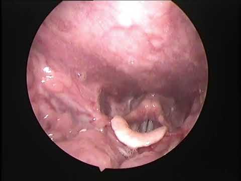 EASY ENDOSCOPIC REMOVAL OF FISH BONE FROM THROAT
