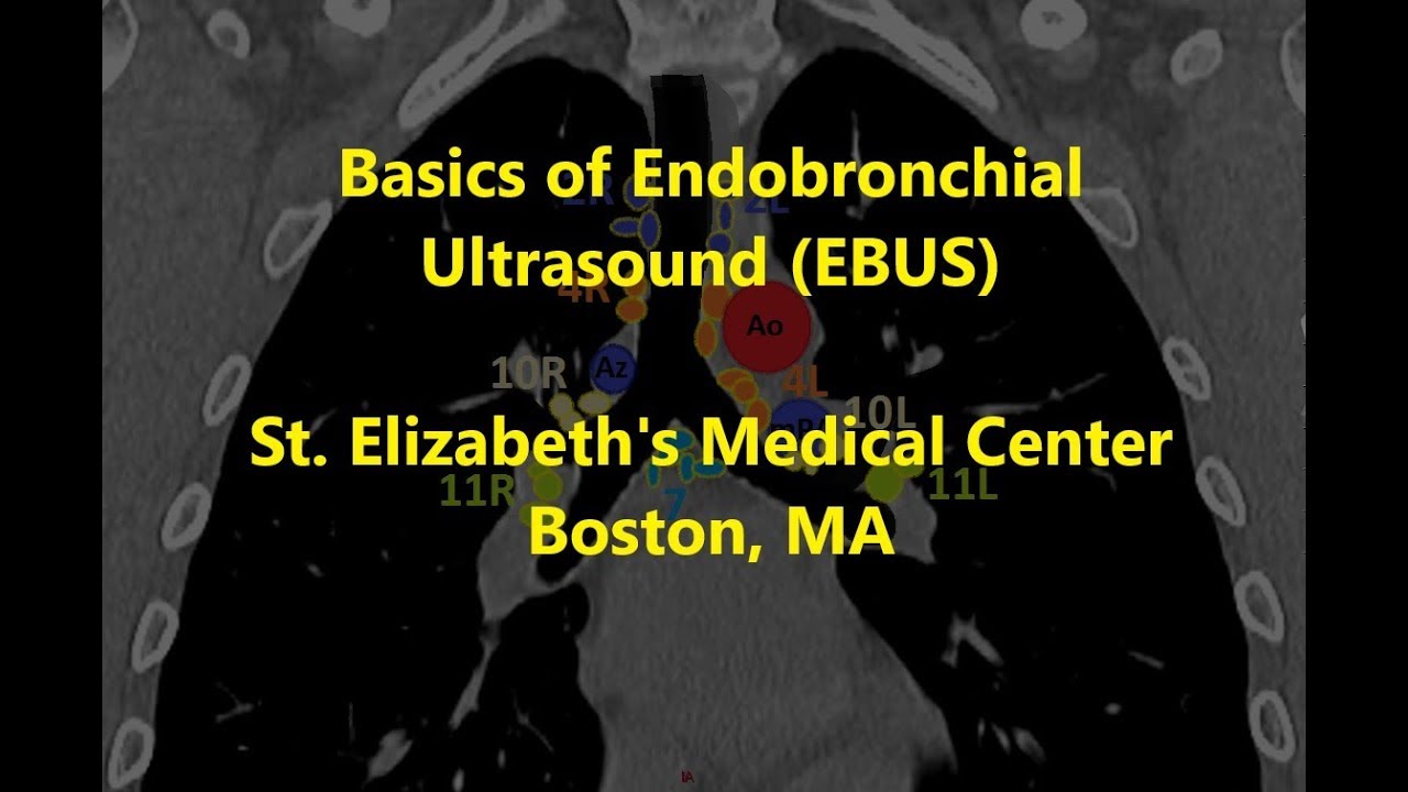 EBUS Basics and Mediastinal Staging -- BAVLS
