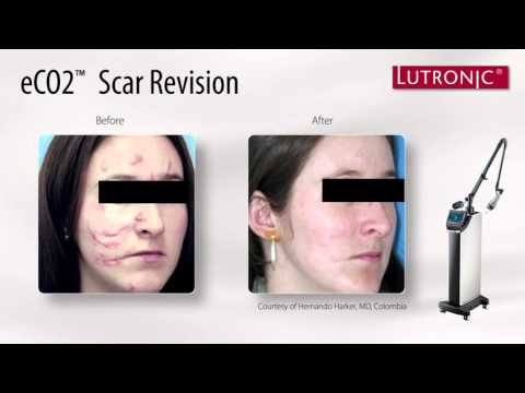 eCO2 CO2 Fractional skin resurfacing Laser
