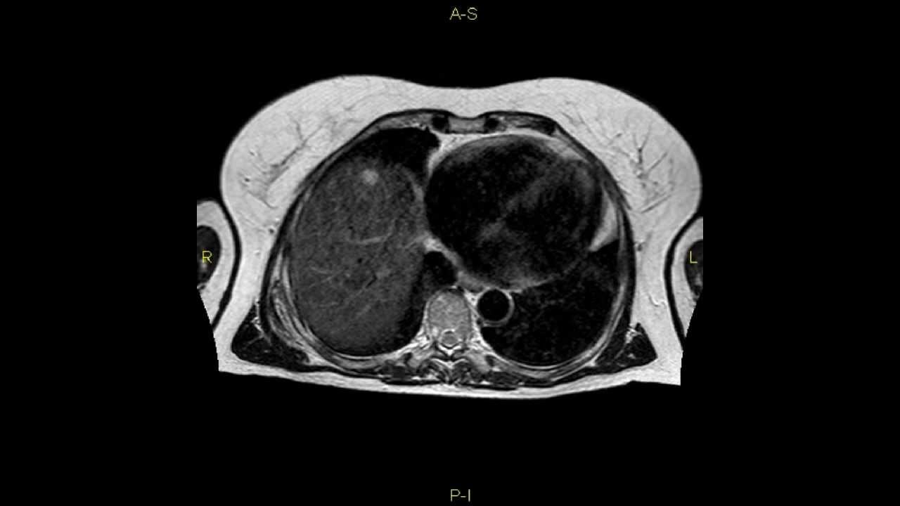 Elastofibroma dorsi - complete MRI examination