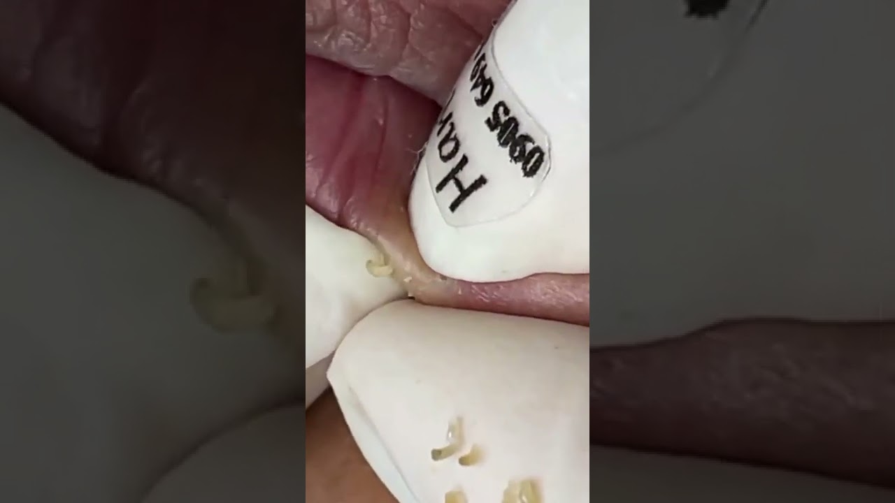Eliminación De Puntos Negros De Los Labios