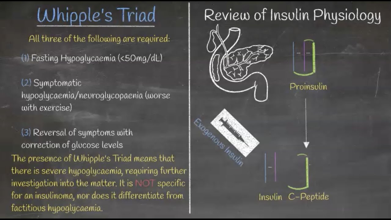 Endocrinology & Cancer - Hypoglycaemia