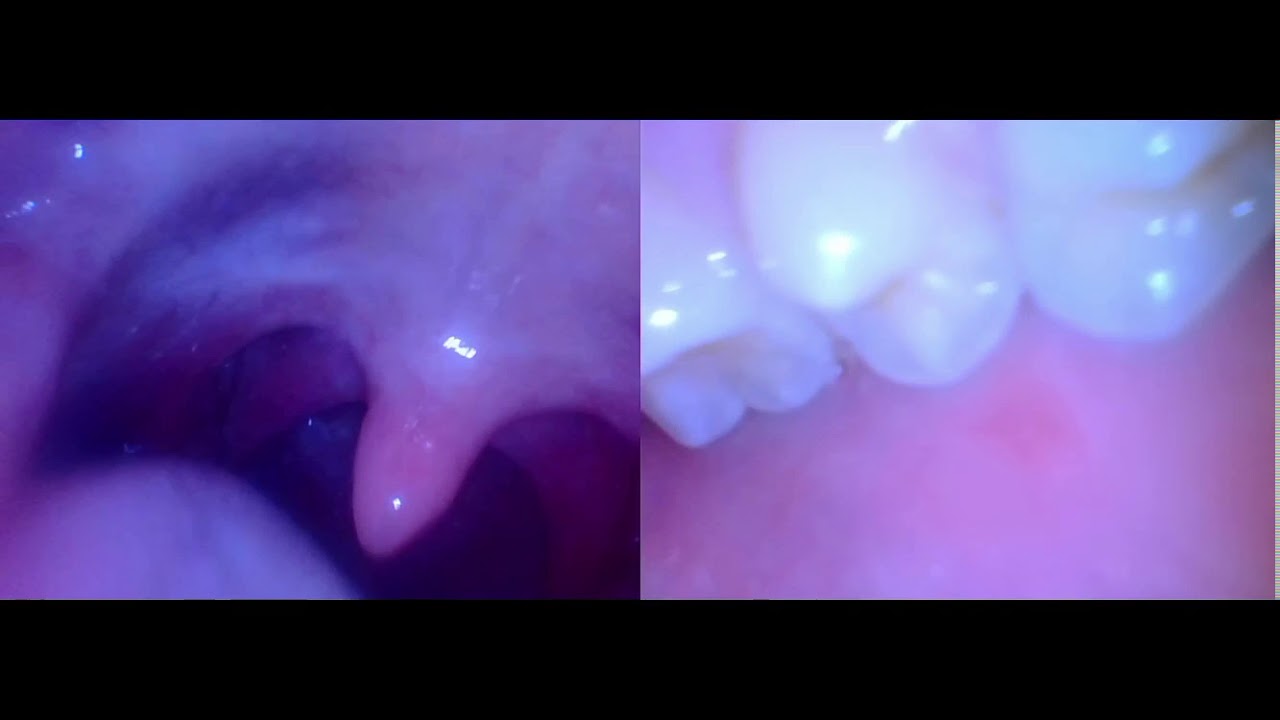 endoscope with two cameras vore