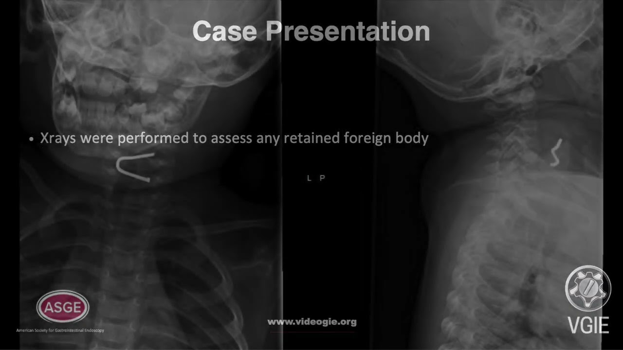 Endoscopic Object and Nail Retrieval Vore
