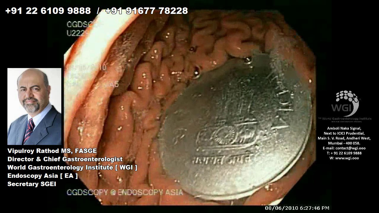 Endoscopic procedure for foreign body removal (Coin removal)