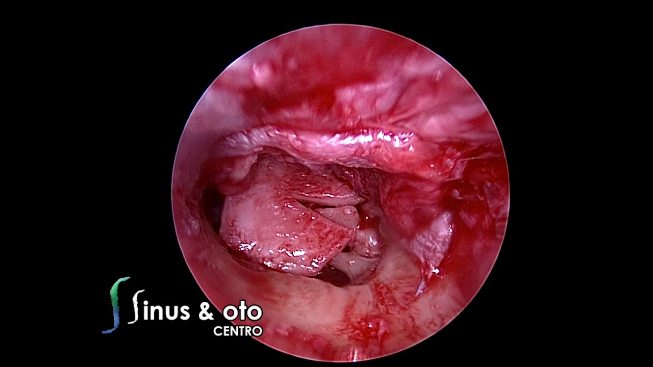 Endoscopic Tympanoplasty - Tympanic Isthmus Surgery and Pac-Man Tympanoplasty
