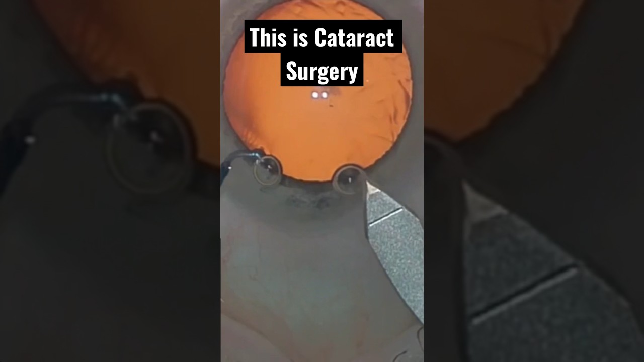 Entire CATARACT surgery in less than a minute
