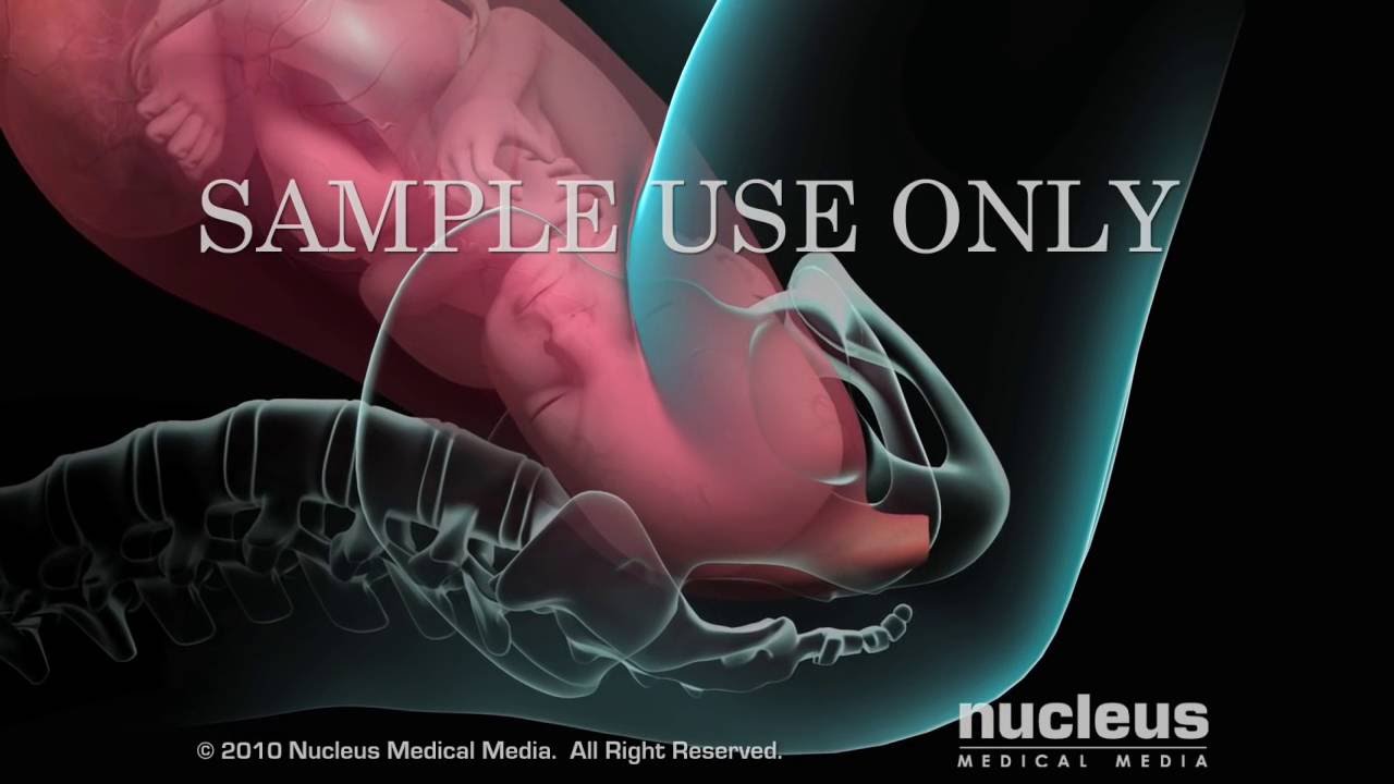 Episiotomy
