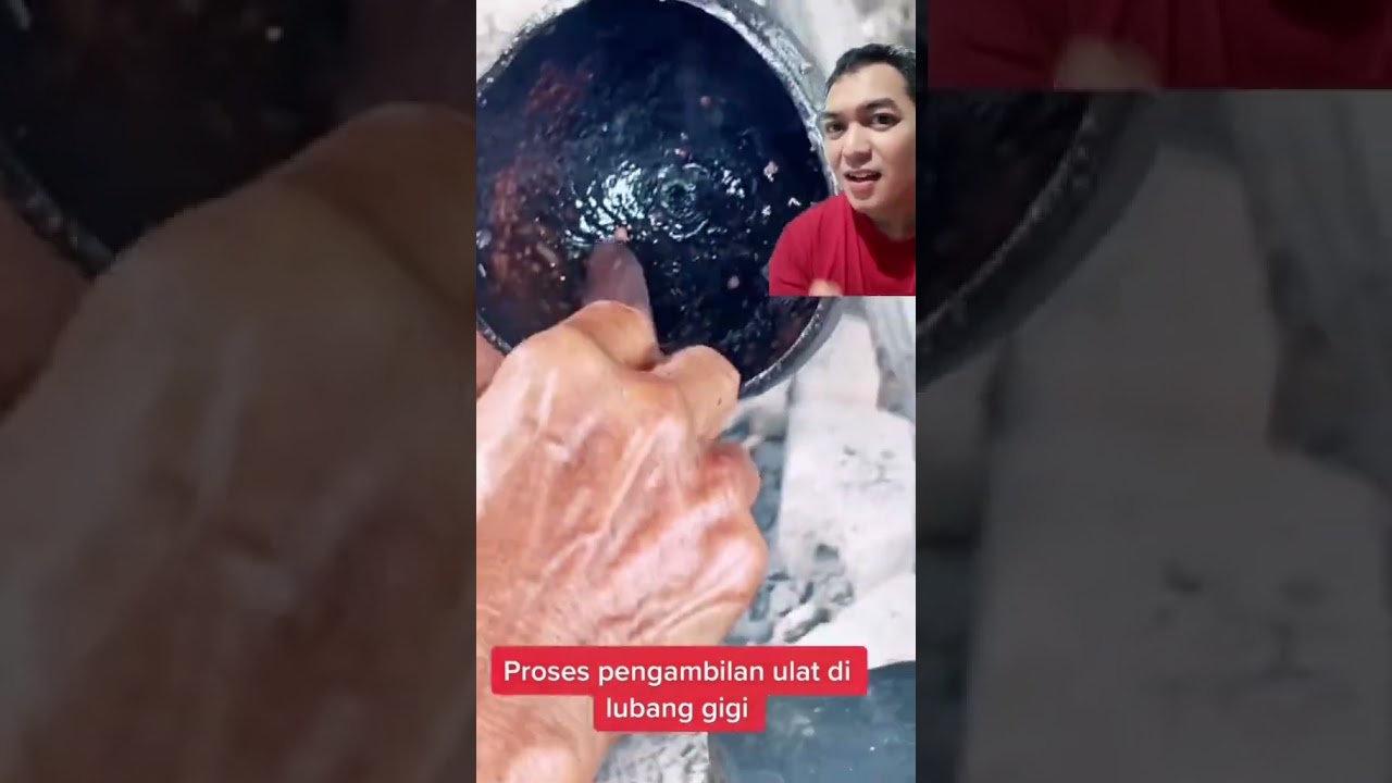 Episode 1 : ULat di gigi yang berlubang #doktergigi #mitosataufakta