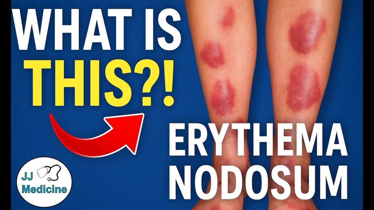 Erythema Nodosum (Red Lumps on Legs) | Causes, Signs & Symptoms, Diagnosis, Treatment