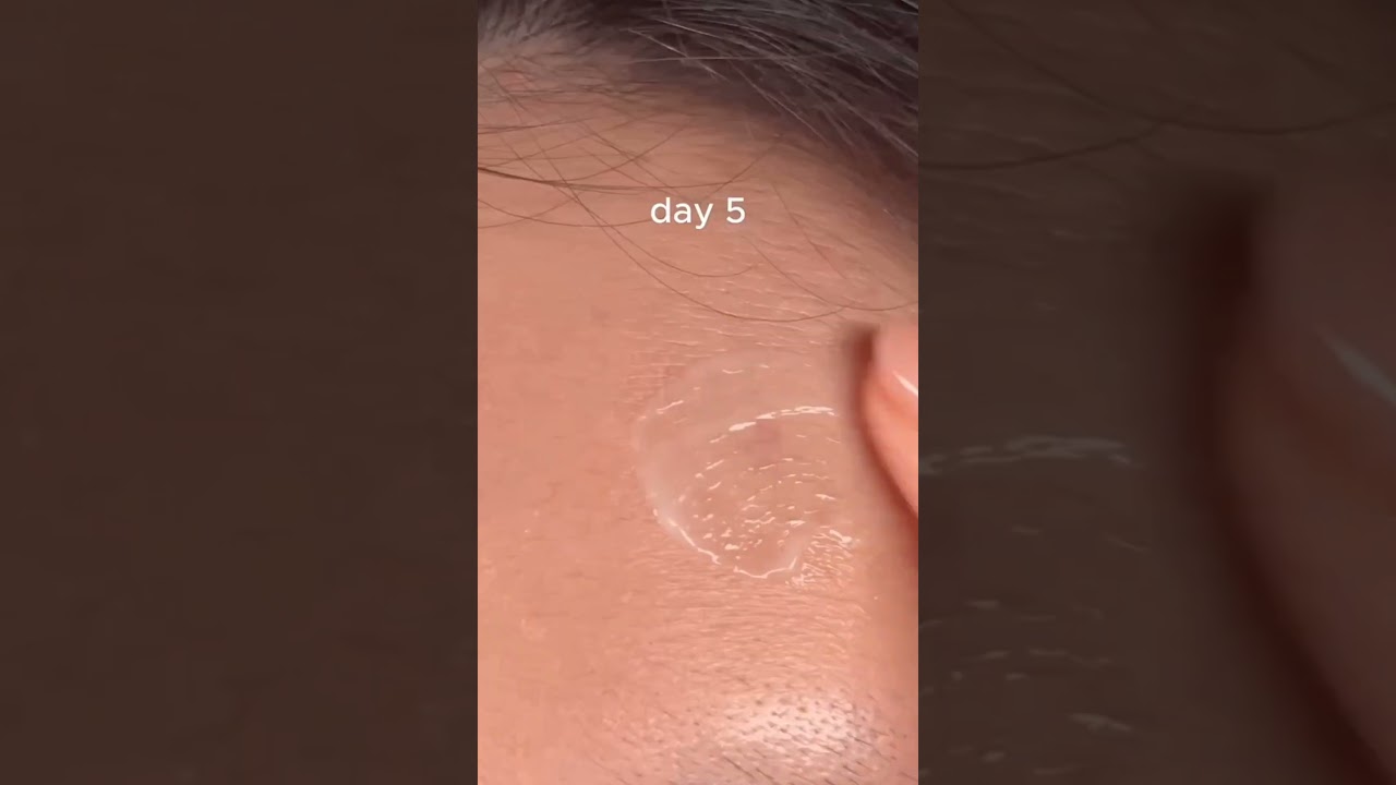 Erytop gel #pimple #acnetreatment #acneproneskincareroutine