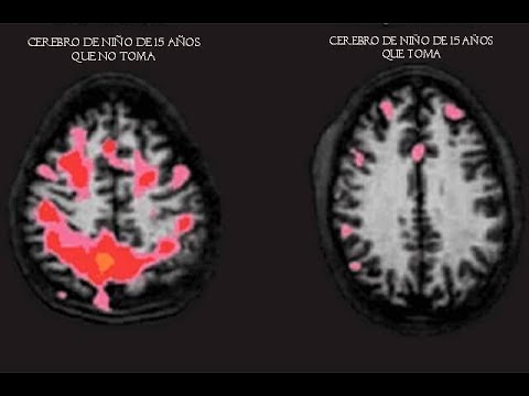 ¿Es menor de edad y toma? Así es cómo el alcohol atrofia el cerebro de un adolescente
