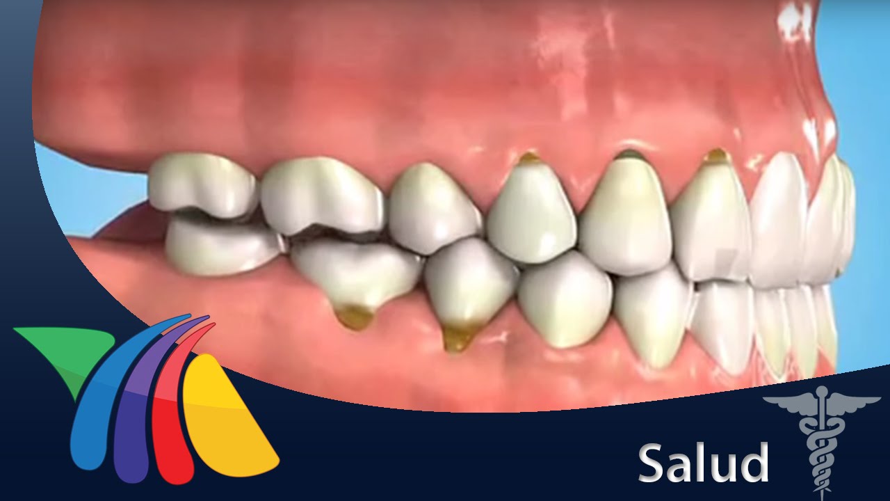 Estrés afecta los dientes | Salud