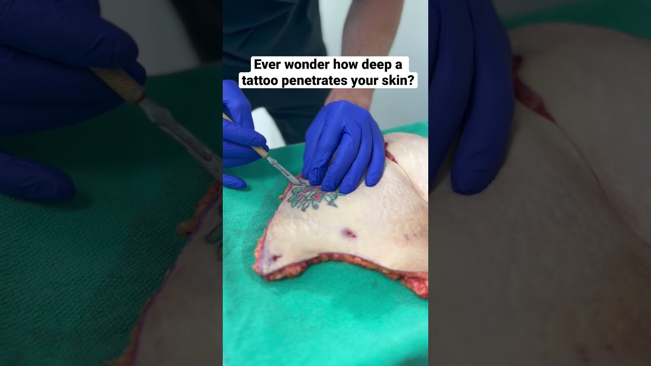 Ever wonder how deep a tattoo penetrates your skin?!😱 #mommymakeover #liposuction #tummytuck