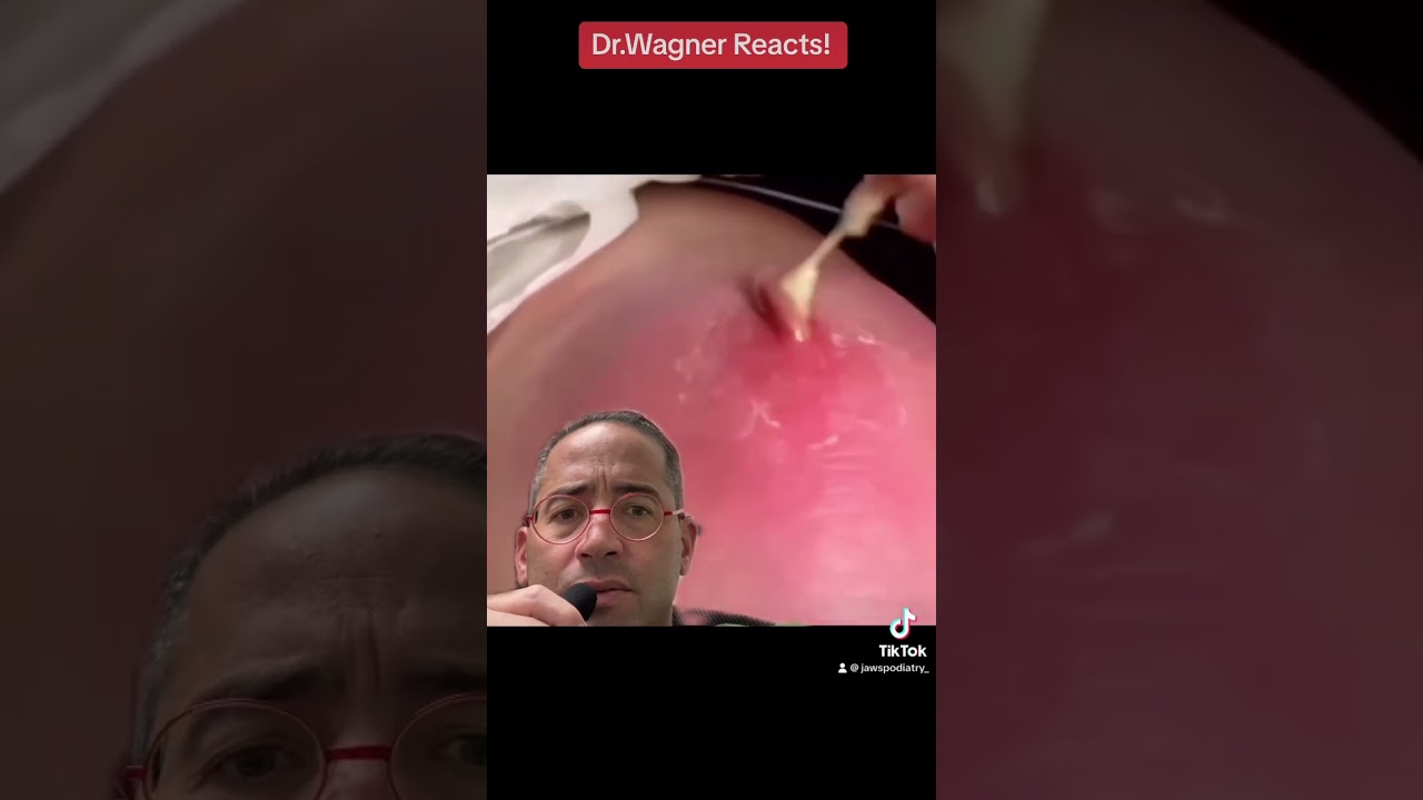 EXPLOSIVE ABSCESS💦#shorts