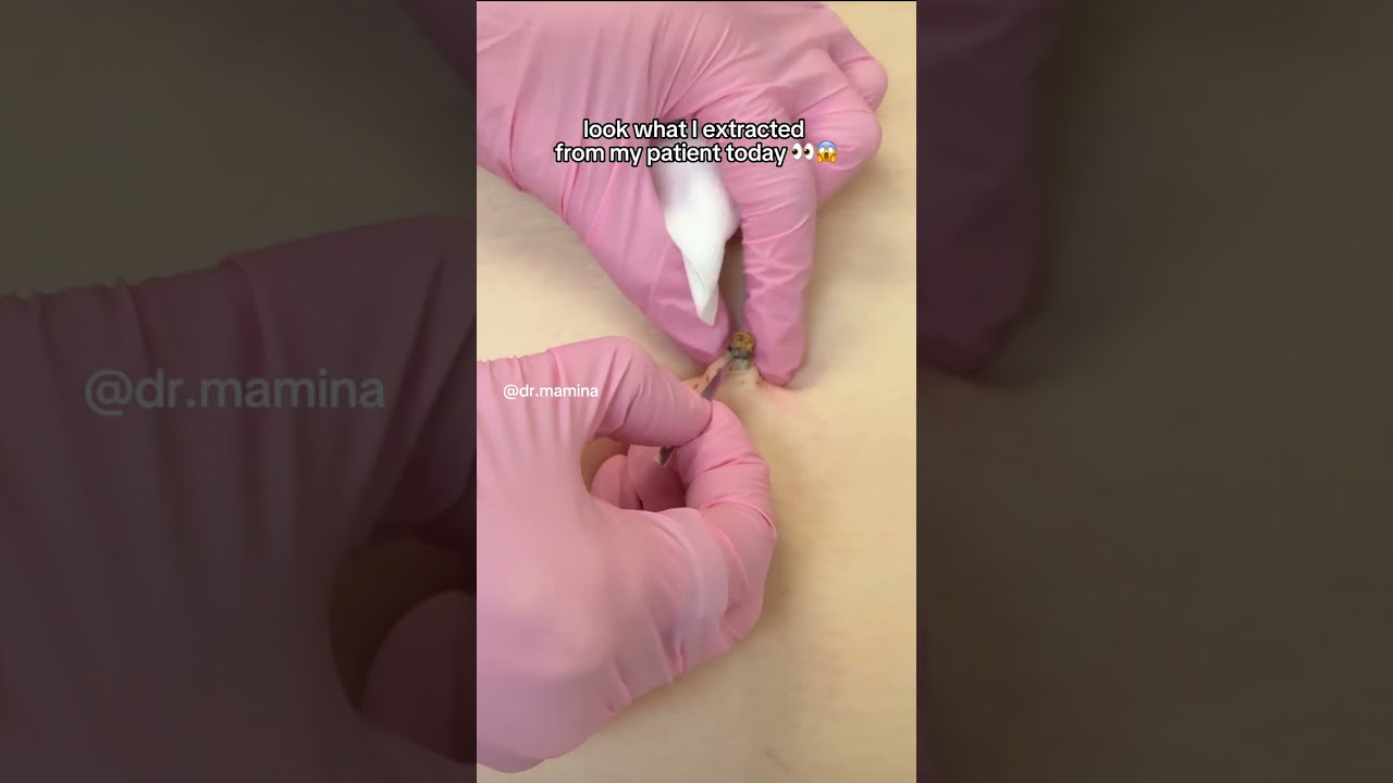 Extraction of an Omphalolith in a Patient's belly button